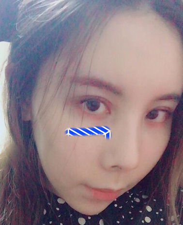 自体脂肪填充