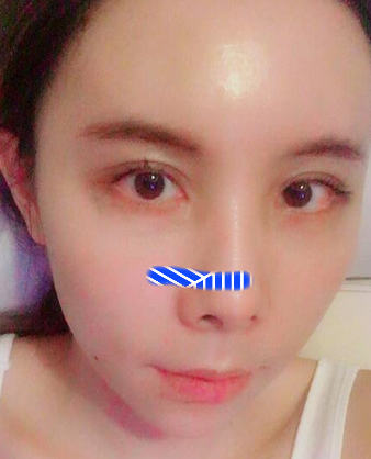 自体脂肪填充