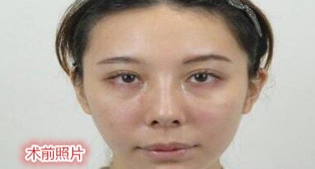 自体脂肪填充