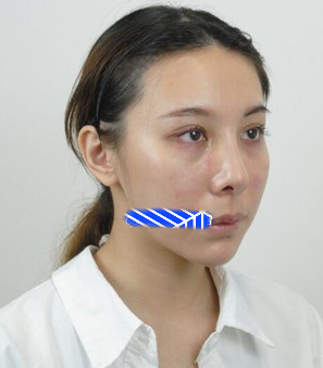 自体脂肪填充