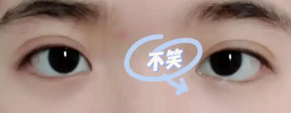 眼袋