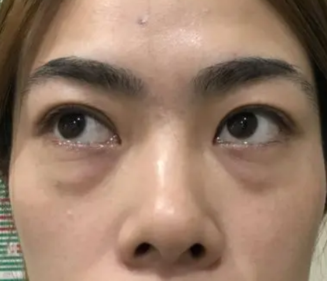 眼袋