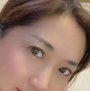 去眼袋手术