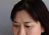 去眼袋手术