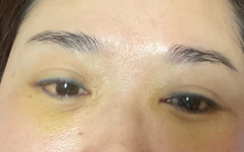 去眼袋手术