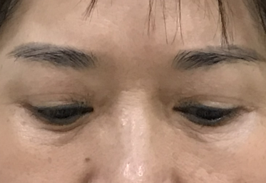 去眼袋手术