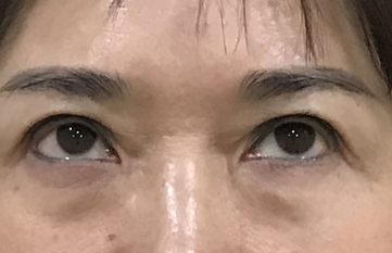 去眼袋手术