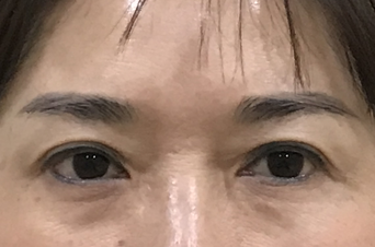 去眼袋手术