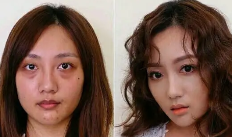 眼袋手术