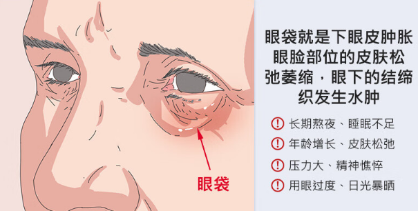眼袋手术