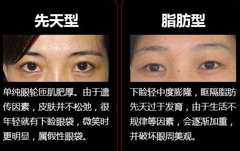 眼袋手术