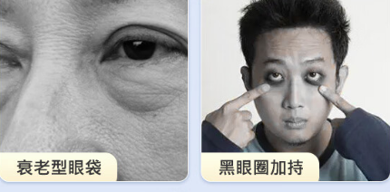 眼袋手术