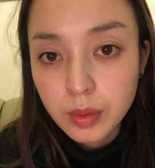 去眼袋手术
