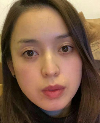 去眼袋手术