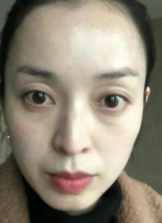 去眼袋手术