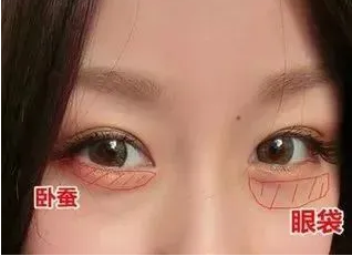去眼袋手术