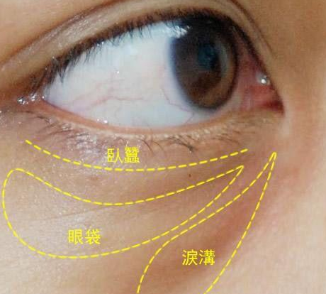 去眼袋手术