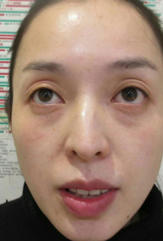 去眼袋手术