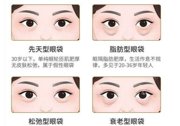 去眼袋手术