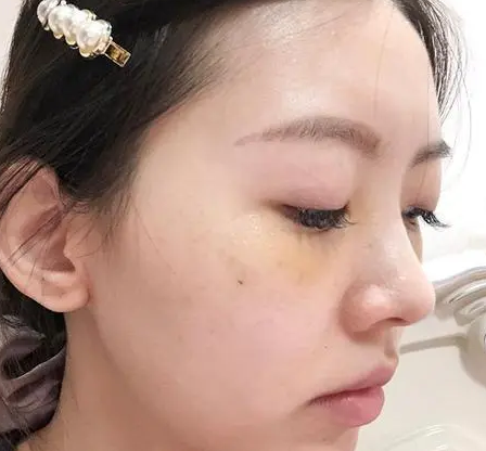 去眼袋手术