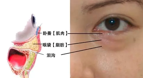 眼袋手术