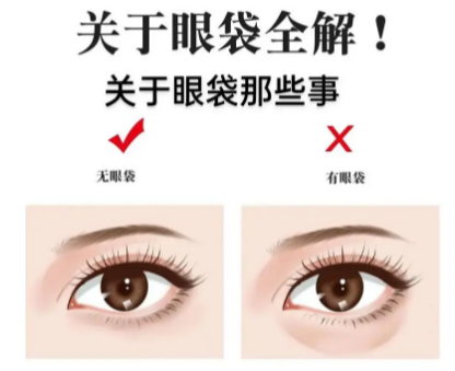眼袋手术