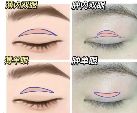 双眼皮