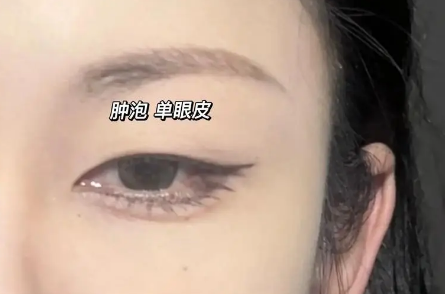 双眼皮