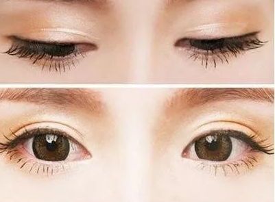 双眼皮手术