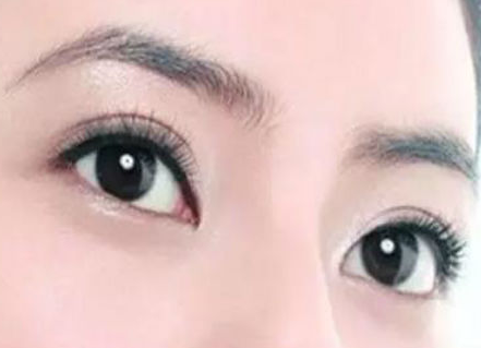 双眼皮手术