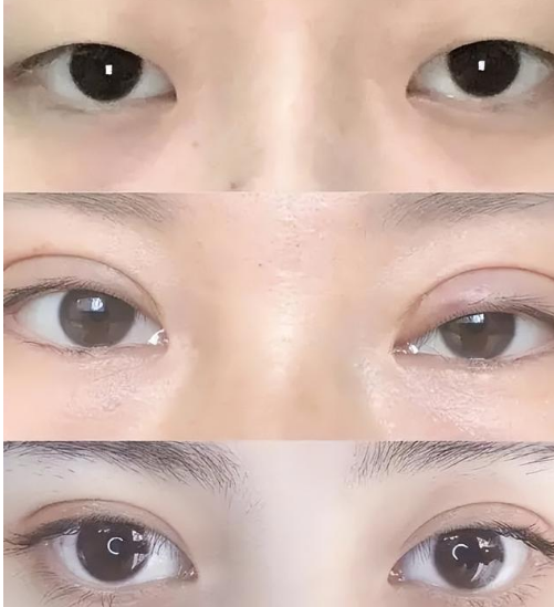 双眼皮手术