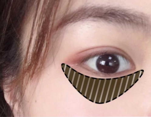 眼袋手术