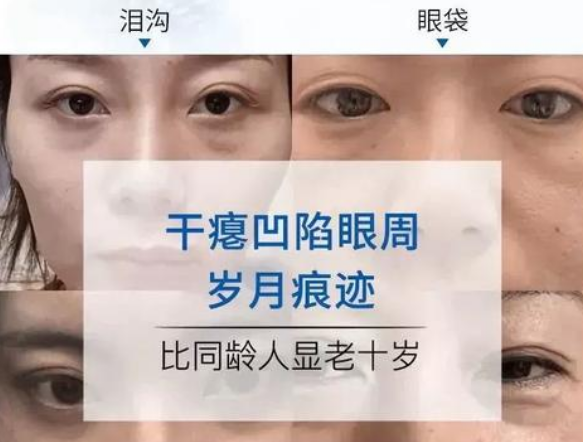眼袋