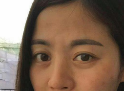 去眼袋手术