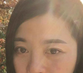 去眼袋手术