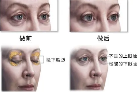 去眼袋手术