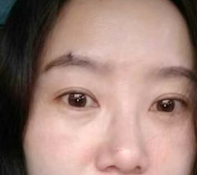 去眼袋手术