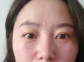 去眼袋手术