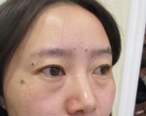 去眼袋手术