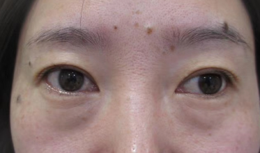 去眼袋手术
