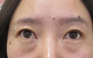 去眼袋手术