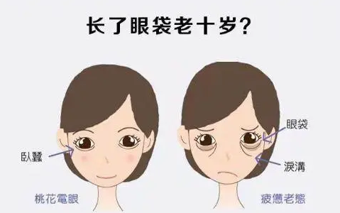 去眼袋手术