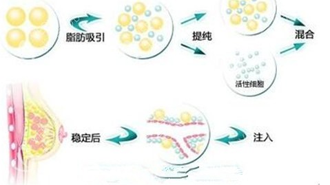 自体脂肪丰胸