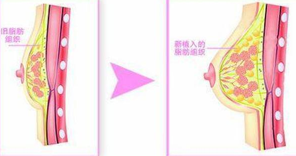 自体脂肪丰胸