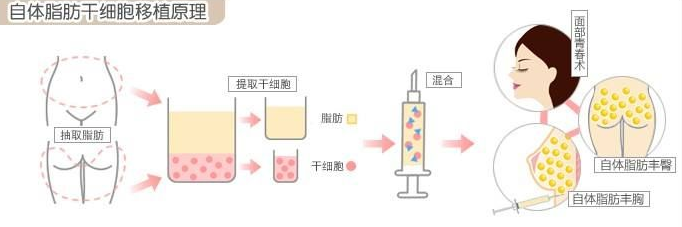 自体脂肪丰胸