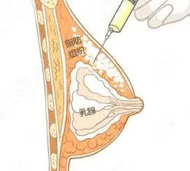自体脂肪丰胸