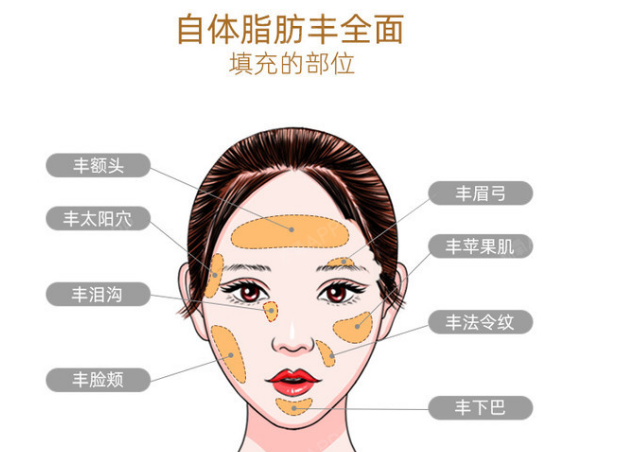 自体脂肪丰胸