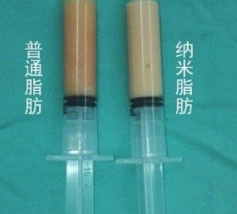 自体脂肪丰胸