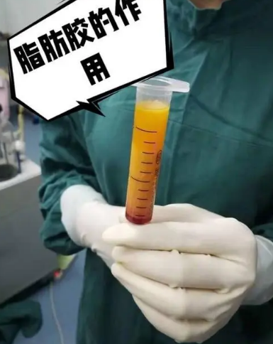 自体脂肪丰胸