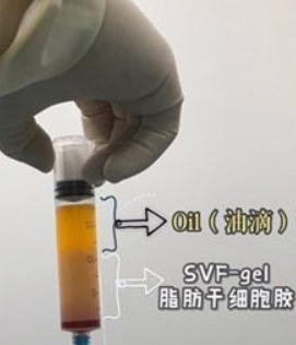 自体脂肪丰胸
